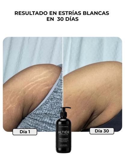 DERMODELUXE - Tratamiento Anti Estrías