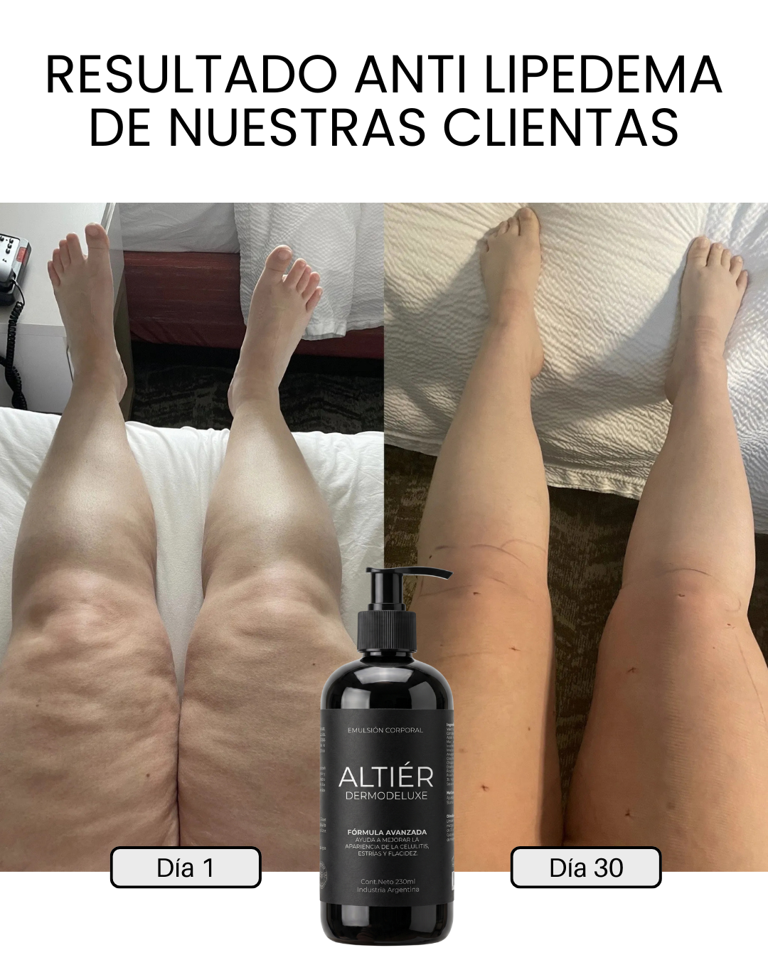 DERMODELUXE - DERMOCOSMÉTICO PARA LIPEDEMA Y CELULITIS AVANZADA