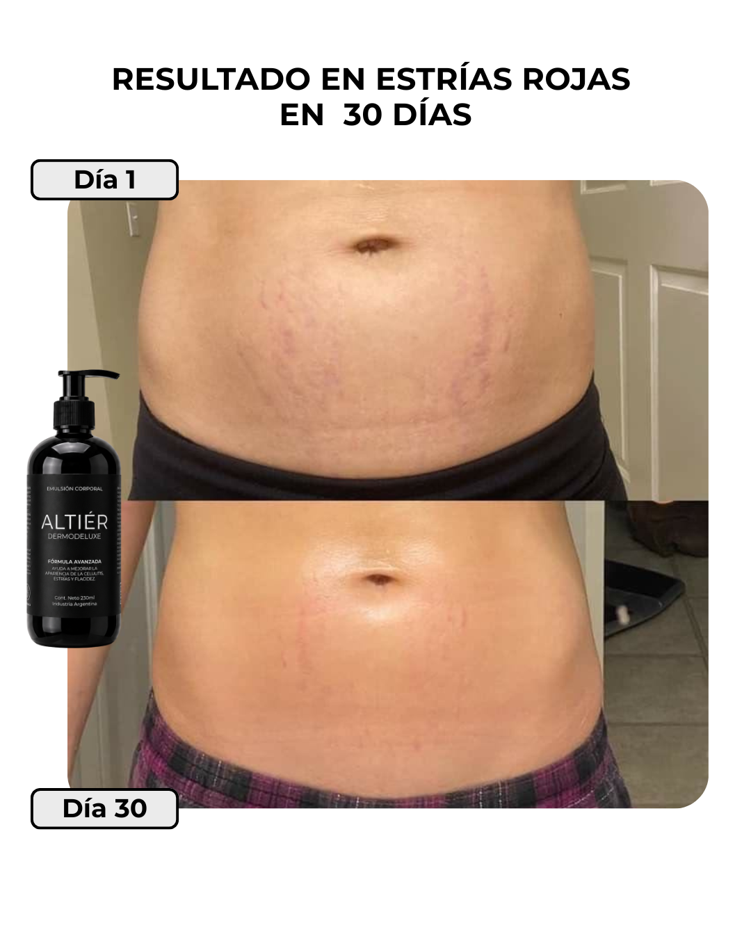 DERMODELUXE - Tratamiento Anti Estrías