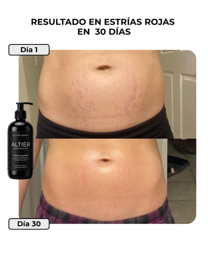 DERMODELUXE - Tratamiento Anti Estrías