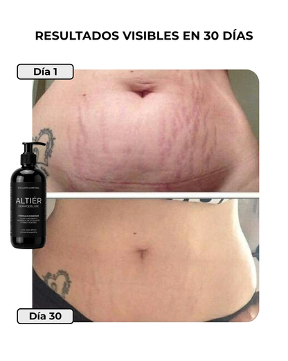 DERMODELUXE - Tratamiento Anti Estrías