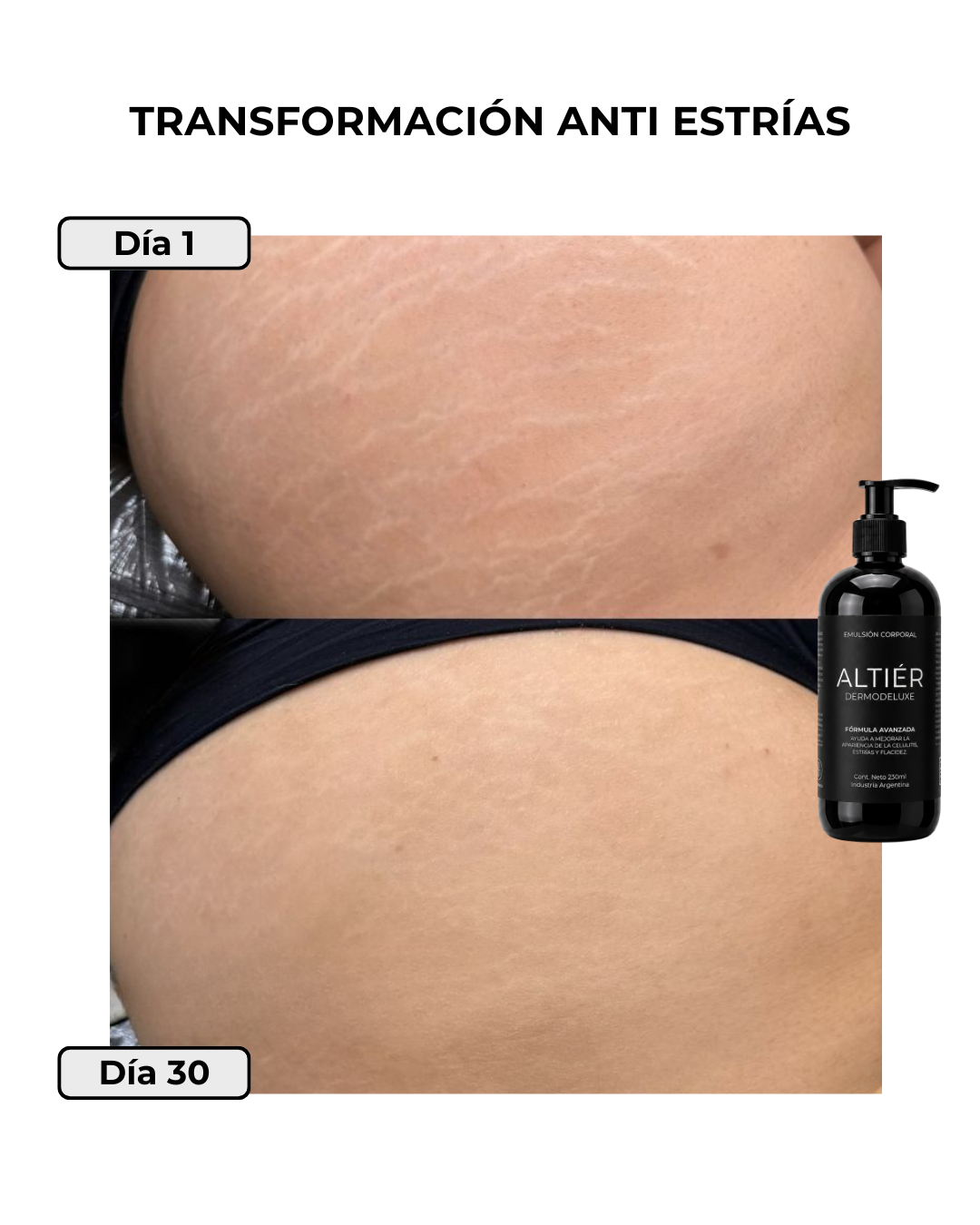 DERMODELUXE - Tratamiento Anti Estrías