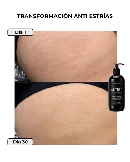 DERMODELUXE - Tratamiento Anti Estrías