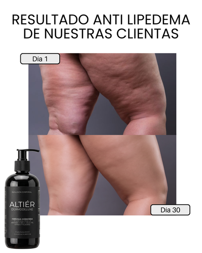 DERMODELUXE - DERMOCOSMÉTICO PARA LIPEDEMA Y CELULITIS AVANZADA